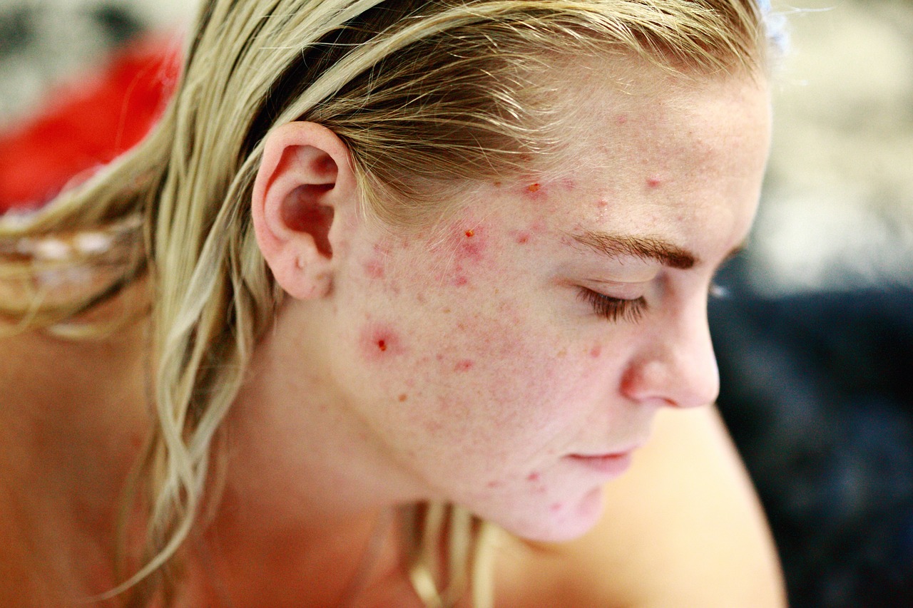 junge Frau mit Akne im Gesicht